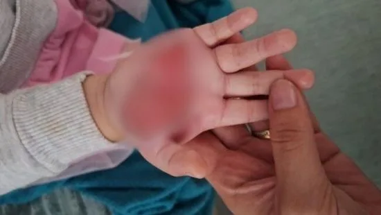 Madrasta é presa em Itajaí por queimar a mão de criança de dois anos com colher aquecida Madrasta é presa em Itajaí por queimar a mão de criança de dois anos com colher aquecida