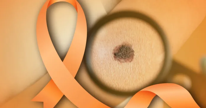 Dezembro Laranja reforça prevenção ao câncer de pele em SC